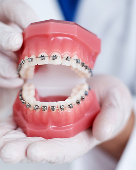 Gloved hands holding dental model with braces